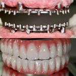 Dental Hybird Malo Implant Bridge Professional Perfect Fit FDA Certified for sale