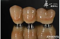 China Rough Surface Design Dental Implant for Subcrestal Bone Level Titanium Material supplier