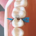 Dentistry Dental Sectional Matrix System Dental Matrices And Wedges Plastic Tulwar Wedges W5 1.0 for sale
