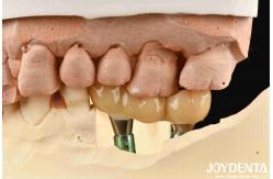 China Implant Crown And Bridge With Customizable Design High Durability Accurate Fit supplier