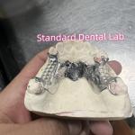 Cobalt Chrome Cast Frame Partial Denture Vitallium 2000 for sale