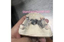 China Cobalt Chrome Cast Frame Partial Denture Vitallium 2000 supplier