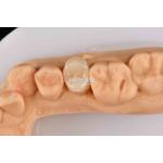 Customizable White Composite Inlay Onlay Natural Looking Minimally Invasive Tooth Restoration