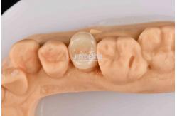 China Customizable White Composite Inlay Onlay Natural Looking Minimally Invasive Tooth Restoration supplier