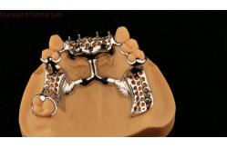 China Upper Cast Framework Acrylic Metal Partial Dentures Strong Lightweight and Durable supplier
