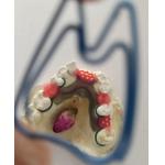 Cr Co Partial Denture Metal Framework