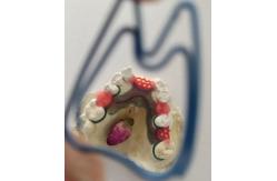 China Cr Co Partial Denture Metal Framework supplier
