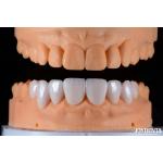 Secure Fit Porcelain Veneers Ceramic and Natural Aesthetics with Strong Adhesion for sale