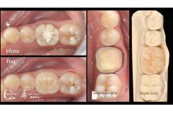 China Biocompatibility And High Compatibility With Natural Teeth Restoration Dental Inlay Restorative supplier