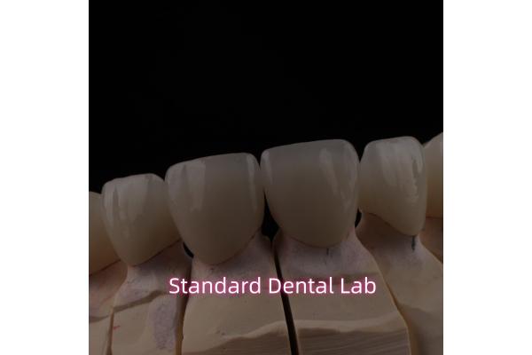 PFZ Dental Layered Ceramic Zirconia Bridge With Incisal Translucent