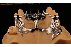 China Upper Cast Framework Acrylic Metal Partial Dentures Strong Lightweight and Durable supplier