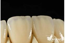 China Bionic Development Leaves And Distinct Layers Of Zirconia All-Ceramic supplier