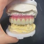 Malo Bridge Hybrid Zirconia All On Four / Six Zirconia Implant Bridge TItanium Bar