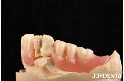 China Lightweight Good Biocompatibility Acrylic Denture Finish Personalized Customization In Medical Equipment supplier