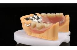 China Metal Alloys Cobalt Chromium Partial Denture Ivoclar Scheftner Comfortable Cast Metal Framewrok supplier