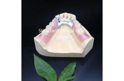 China Acrylic Metal Partial Denture Frameworks High Esthetics SDL dental lab supplier