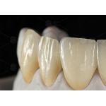 0.3mm-0.7mm Feldspathic EMAX Ceramic Veneers Natural Aesthetic Emax Dental Veneers for sale