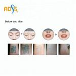 Long Pulse ND YAG Laser Machine 1064nm Laser Pigmentation Removal Machine