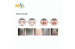 China Long Pulse ND YAG Laser Machine 1064nm Laser Pigmentation Removal Machine supplier