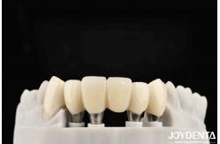 China Customizable Implant Crown And Bridge For Safe Oral Biocompatibility supplier