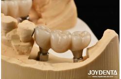 China Zirconia Implants Perfect Match With Natural Teeth Zero Allergy Risk supplier