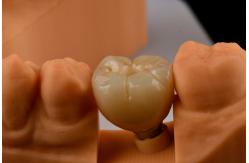China Oral Implantology Self Tapping Single Tooth Dental Implants With Internal Hex Connection supplier