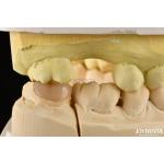 Easy Clean Emax Inlays And Onlays Hypoallergenic Biocompatible Dental Restorations
