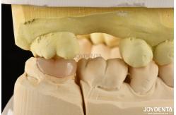 China Easy Clean Emax Inlays And Onlays Hypoallergenic Biocompatible Dental Restorations supplier