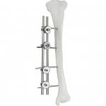 Orthopedic Implant Femur Tibial External Fixator Bone Surgery Fixator for sale