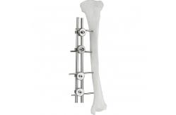 China Orthopedic Implant Femur Tibial External Fixator Bone Surgery Fixator supplier