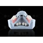 Titanium Dental Implant Ball Attachments Comfortable Secure Denture Retention for sale