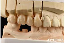 China Multilayer Full Zirconia White Style With Layers High Translucency High Resistance To Cracking supplier
