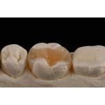 E Max Material Inlay And Onlay In Dentistry Aesthetic Restoration Long Lasting for sale