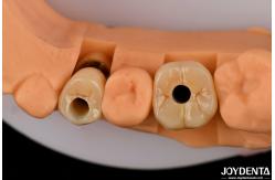 China Customizable Implant Crown and Bridge Achieve a Natural Look with Long-lasting Results supplier
