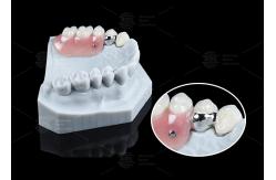 China MK1 Precision Attachment Removable Partial Denture Easy Installation supplier