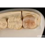 Easy Clean Emax Inlays And Onlays Hypoallergenic Biocompatible Dental Restorations for sale