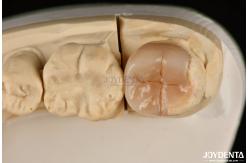 China Easy Clean Emax Inlays And Onlays Hypoallergenic Biocompatible Dental Restorations supplier