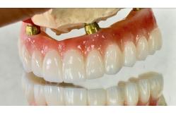 China Dental All On X Implant PFM Crown Titanium Fixed Hybrid Denture supplier