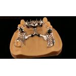 Upper Cast Framework Acrylic Metal Partial Dentures Strong Lightweight and Durable
